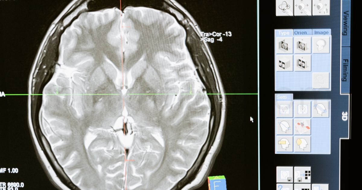 Brain MRI scan displayed on medical interface, representing brain-computer interface and neurological research
